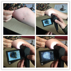 حرفه ای الکترونیکی Dermatoscope بازرسی پوست با میکرو کارت SD