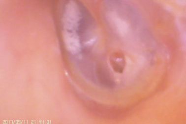 اوتوسکوپ دیجیتال دیجیتال گوش و بینی سونوگرافی برای پرکردن غشای تمپان
