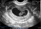 اسکنر حاملگی قابل حمل داخل واژن برای سونوگرافی قابل حمل OB/GYN