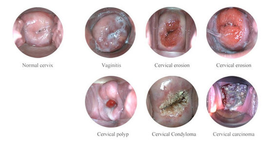 کولپوسکوپ الکترونیک دیجیتال قابل حمل