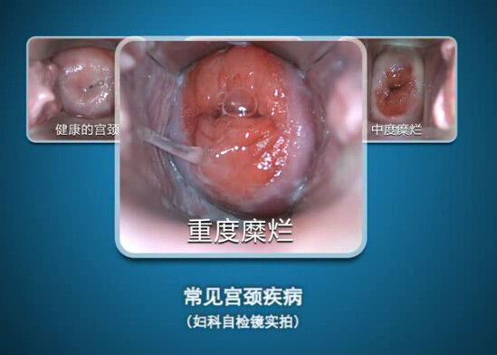 آندوسکوپ دیجیتال خود کولپوسکوپی مینی کولپوسکوپی با محدوده مشاهده 100 mm 70 میلی متر