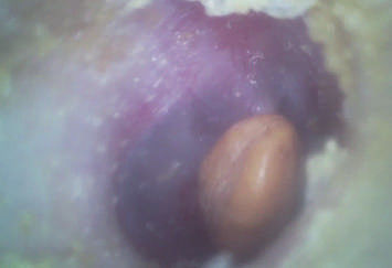 اتوسکوپ تصویری دیجیتال دستی دستی گوش و حلق و بینی قابل حمل با فلش کارت Micro SD 32G