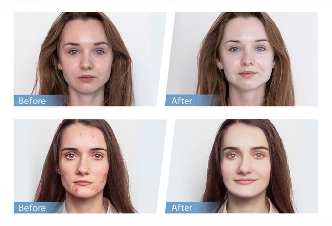 فروش کارخانه قلم هیدرا H5 EMS قلم الکتریکی برای بازسازی کلاژن رشد مجدد مو و ریش استفاده در خانه و سالن 4